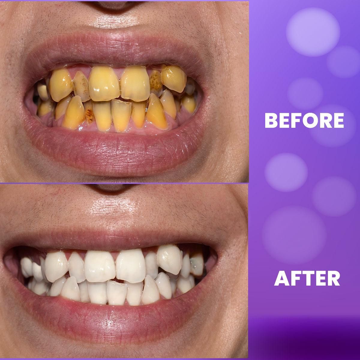 Purple Teeth Whitening Gel - Premium  from Mystical9 - Just Rs 599 /- Shop now at Mystical9.com